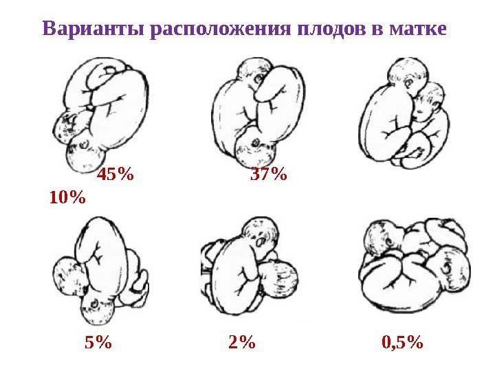 Варианты расположения плодов в матке  45    37   