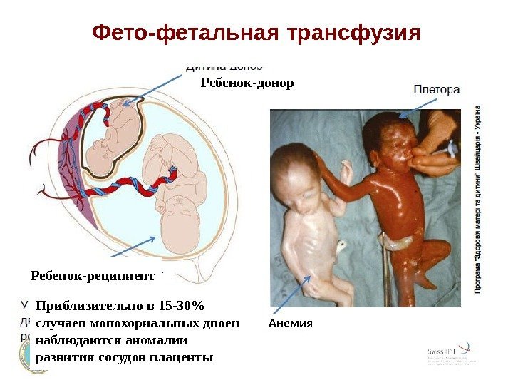 Фето-фетальная трансфузия Ребенок-донор Ребенок-реципиент Анемия. Приблизительно в 15 -30 случаев монохориальных двоен наблюдаются аномалии
