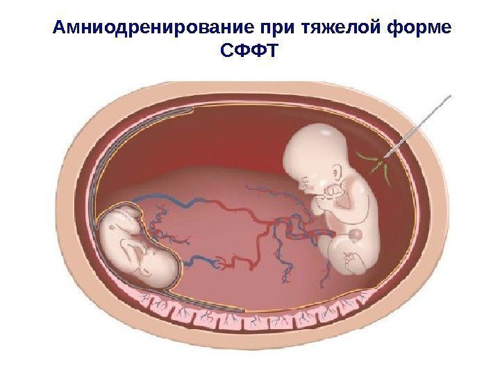 Амниодренирование при тяжелой форме СФФТ 