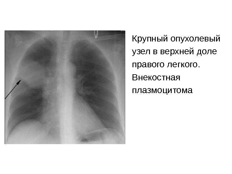 Крупный опухолевый узел в верхней доле правого легкого. Внекостная плазмоцитома 