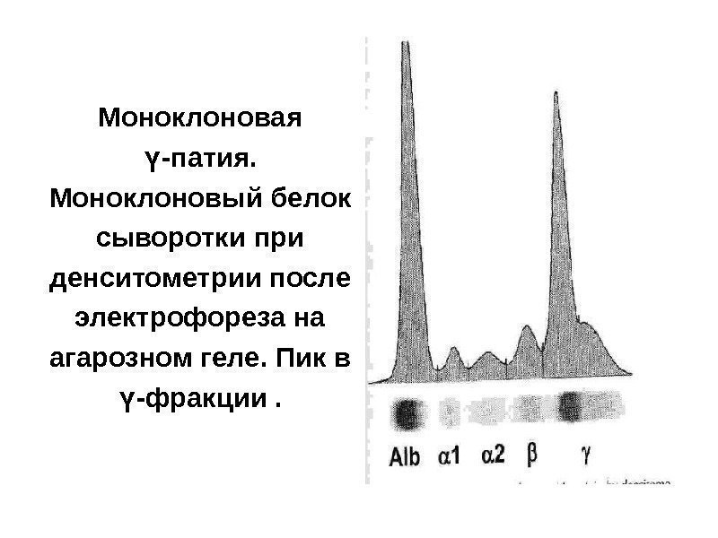 Моноклоновая -патия. ү Моноклоновый белок сыворотки при денситометрии после электрофореза на агарозном геле. Пик