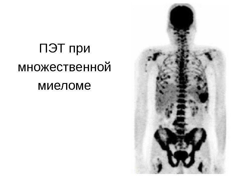 ПЭТ при множественной миеломе 