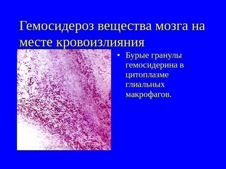   Гемосидероз вещества мозга на месте кровоизлияния  • Бурые гранулы гемосидерина в