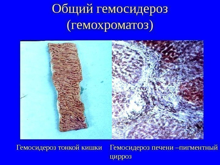   Общий гемосидероз (гемохроматоз) Гемосидероз тонкой кишки Гемосидероз печени –пигментный цирроз 
