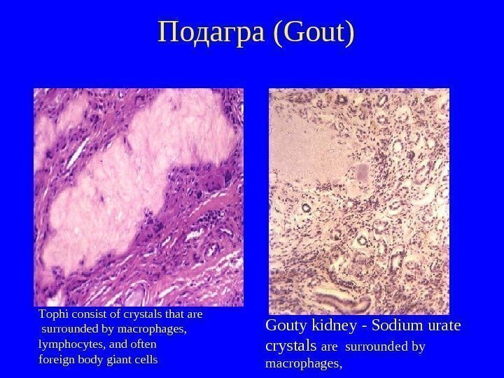   Подагра (Gout) Тophi consist of crystals that are  surrounded by macrophages,