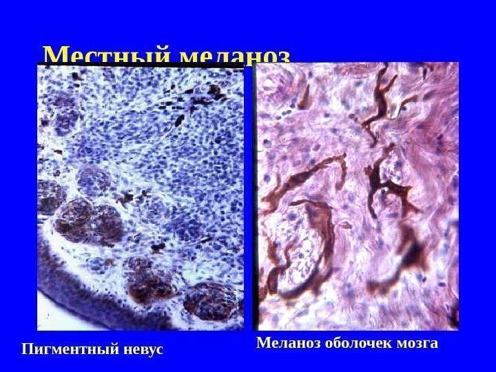   Местный меланоз  Пигментный невус  Меланоз оболочек мозга  