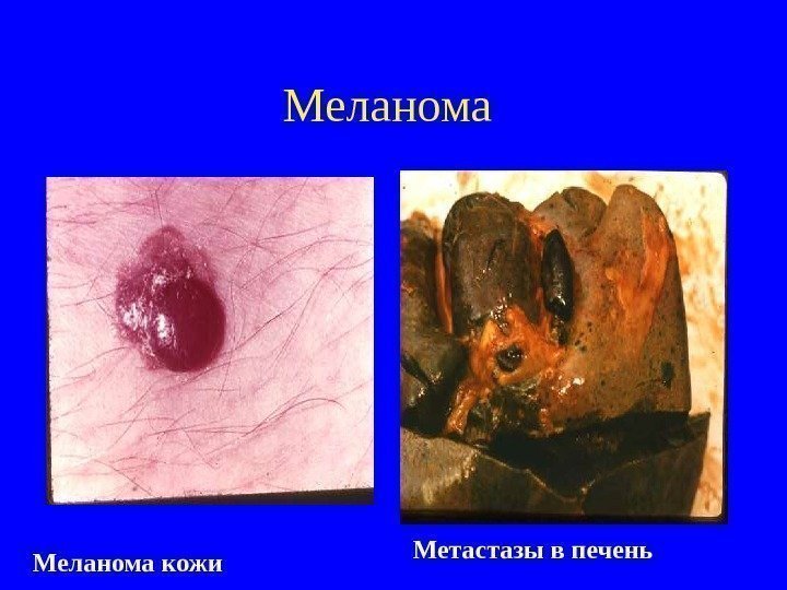   Меланома кожи Метастазы в печень 