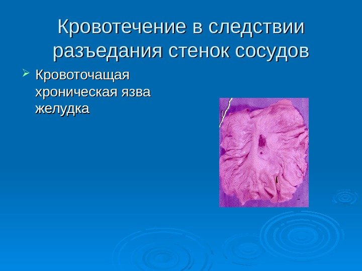 Кровотечение в следствии разъедания стенок сосудов Кровоточащая хроническая язва желудка 