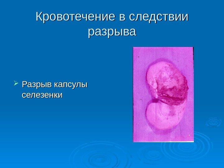 Кровотечение в следствии разрыва Разрыв капсулы селезенки 