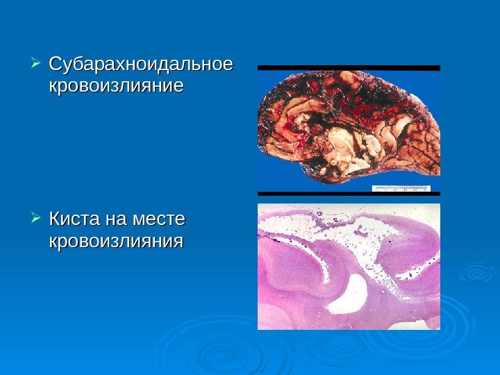  Субарахноидальное кровоизлияние Киста на месте кровоизлияния 