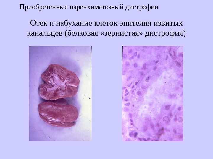   Отек и набухание клеток эпителия извитых канальцев (белковая «зернистая» дистрофия)Приобретенные паренхиматозный дистрофии