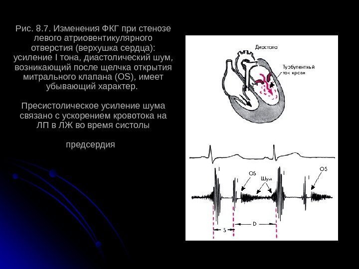Рис. 8. 7. Изменения ФКГ при стенозе левого атриовентикулярного отверстия (верхушка сердца):  усиление