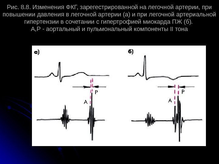 Рис. 8. 8. Изменения ФКГ, зарегестрированной на легочной артерии, при повышении давления в легочной