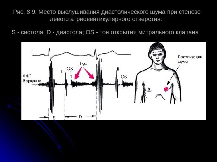 Рис. 8. 9. Место выслушивания диастолического шума при стенозе левого атриовентикулярного отверстия.  S