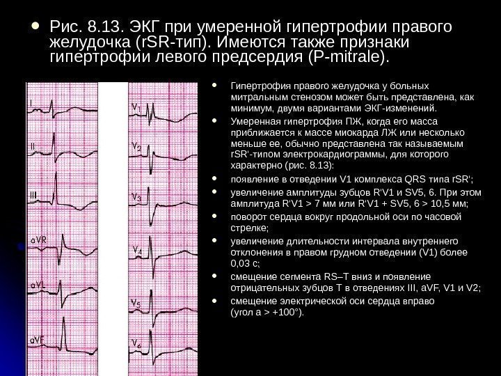  Рис. 8. 13. ЭКГ при умеренной гипертрофии правого желудочка (r. SR-тип). Имеются также