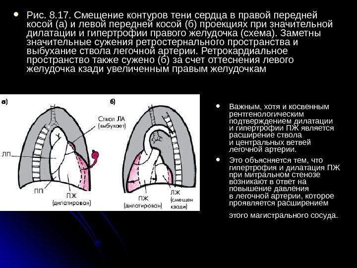  Рис. 8. 17. Смещение контуров тени сердца в правой передней косой (а) и