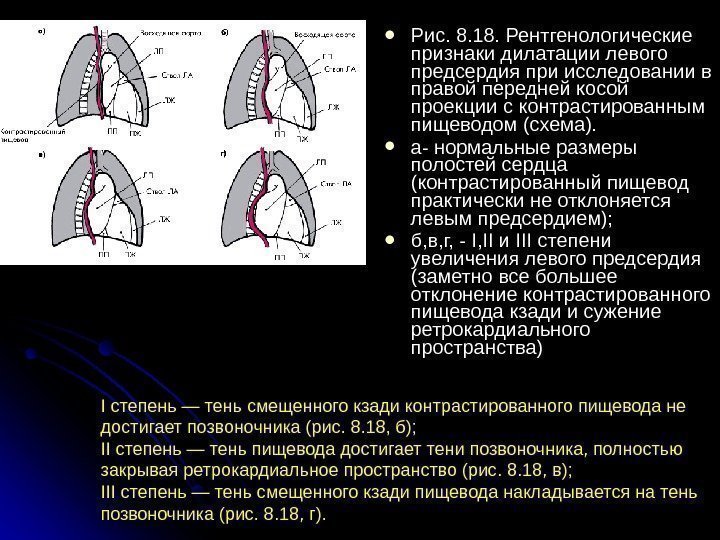  Рис. 8. 18. Рентгенологические признаки дилатации левого предсердия при исследовании в правой передней