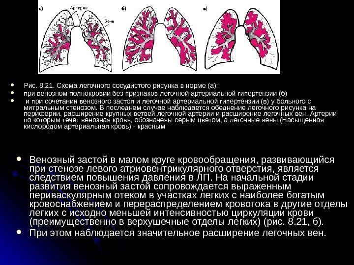  Венозный застой в малом круге кровообращения, развивающийся при стенозе левого атриовентрикулярного отверстия, является