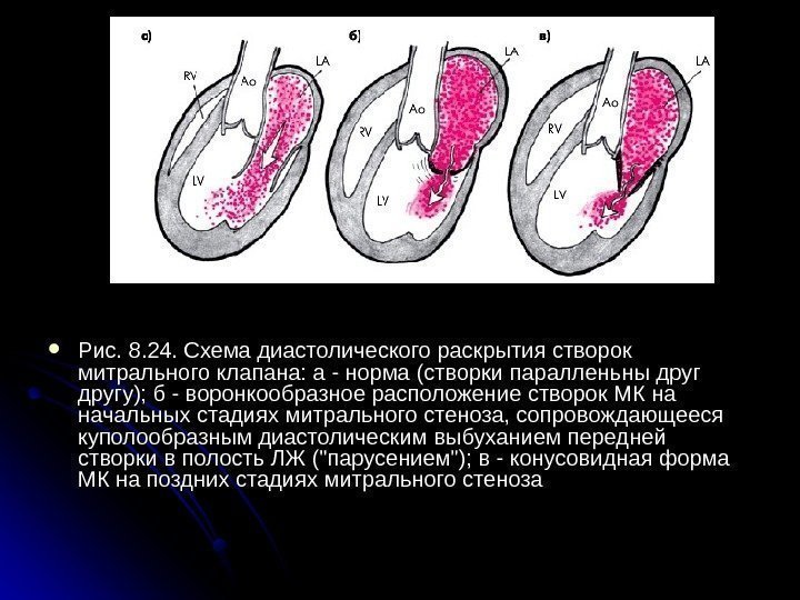  Рис. 8. 24. Схема диастолического раскрытия створок митрального клапана: а - норма (створки