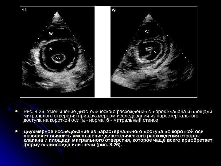  Рис. 8. 26. Уменьшение диастолического расхождения створок клапана и площади митрального отверстия при