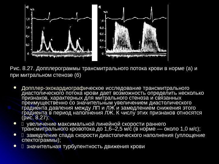  Допплер-эхокардиографи ческое исследование трансмитрального диастолического потока крови дает возможность определить несколько признаков, характерных