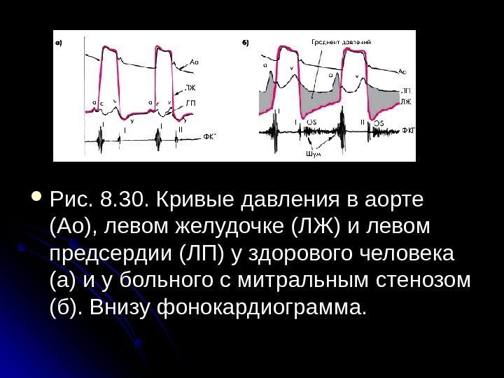  Рис. 8. 30. Кривые давления в аорте (Ао), левом желудочке (ЛЖ) и левом