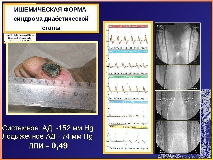 ИШЕМИЧЕСКАЯ ФОРМА синдрома диабетической стопы Системное АД -1 52 мм Hg Лодыжечное АД -