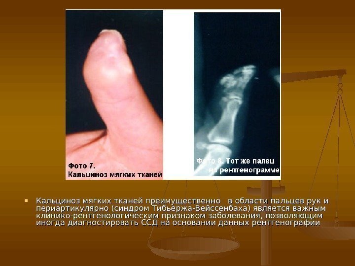  Кальциноз мягких тканей преимущественно  в области пальцев рук и периартикулярно (синдром Тибьержа-Вейссенбаха)