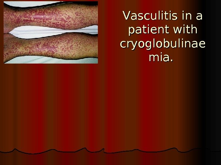   VV asculitis in a patient with cryoglobulinae mia.  