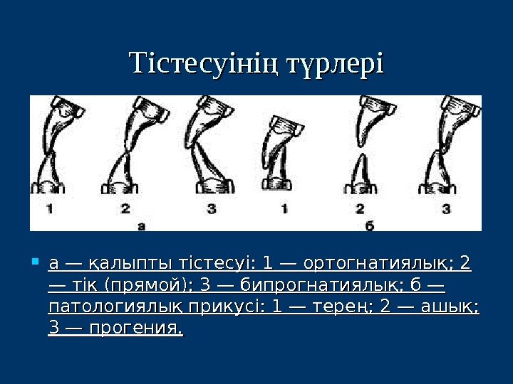 Тістесуіні т рлерің ү а — қалыпты тістесуі: 1 — ортогнатиялық; 2 — тік