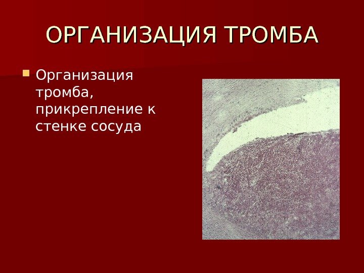   ОРГАНИЗАЦИЯ ТРОМБА Организация тромба,  прикрепление к стенке сосуда 