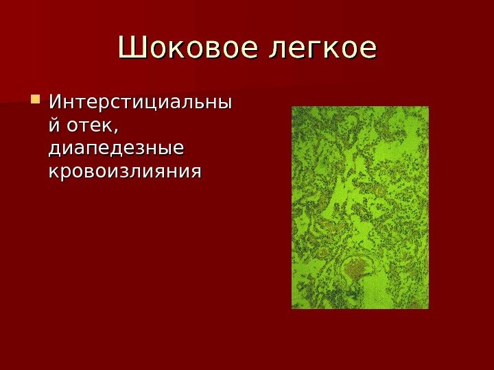   Шоковое легкое Интерстициальны й отек,  диапедезные кровоизлияния 