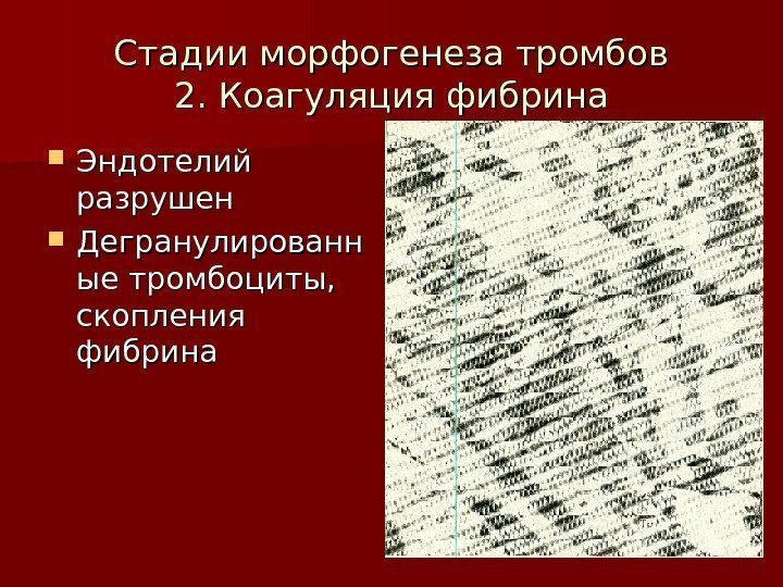   Стадии морфогенеза тромбов 2. Коагуляция фибрина Эндотелий разрушен Дегранулированн ые тромбоциты, 