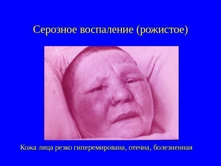   Серозное воспаление (рожистое) Кожа лица резко гиперемирована, отечна, болезненная 