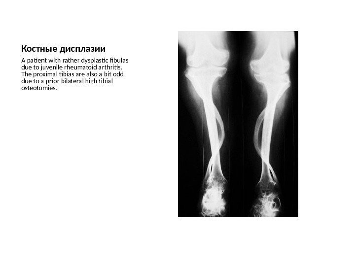 Костные дисплазии A patient with rather dysplastic fibulas due to juvenile rheumatoid arthritis. 