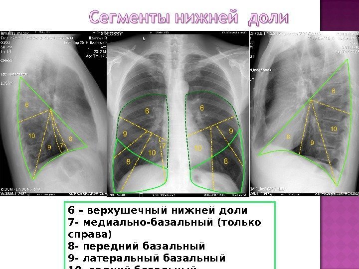 6 – верхушечный нижней доли 7 - медиально-базальный (только справа) 8 - передний базальный