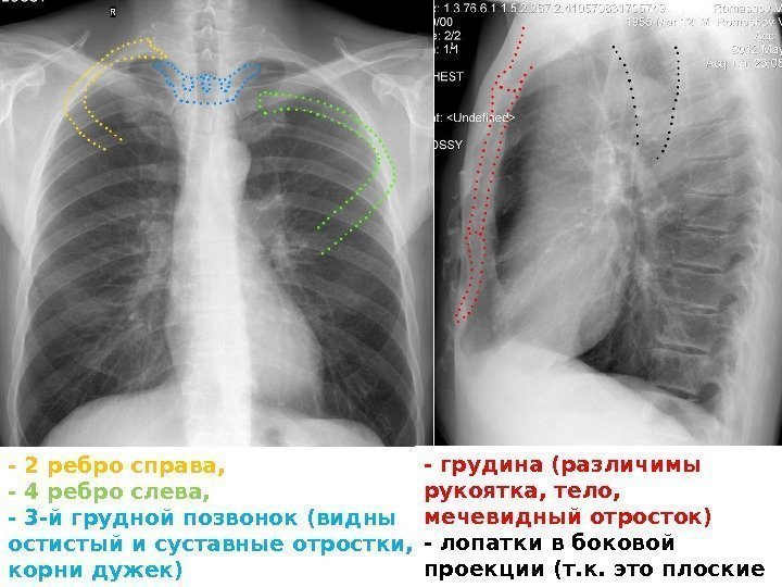 - 2 ребро справа,  - 4 ребро слева, - 3 -й грудной позвонок