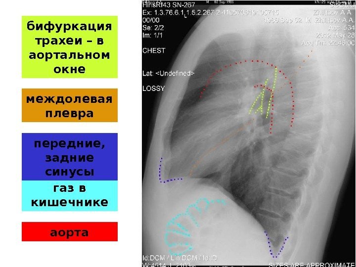 газ в кишечникебифуркация трахеи – в аортальном окне передние,  задние синусымеждолевая плевра аорта
