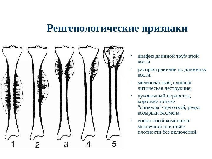 Ренгенологические признаки • диафиз длинной трубчатой кости • распространение по длиннику кости,  •