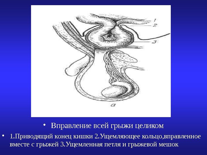   • Вправление всей грыжи целиком • 1. Приводящий конец кишки 2. Ущемляющее