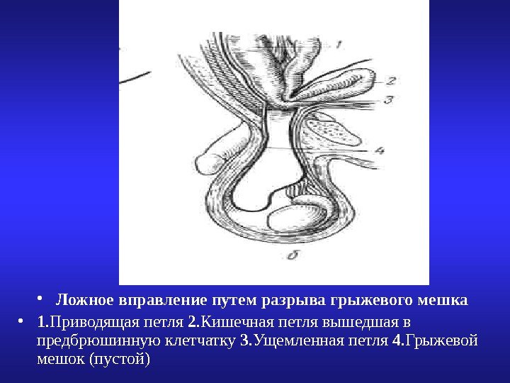   • Ложное вправление путем разрыва грыжевого мешка • 1. Приводящая петля 2.