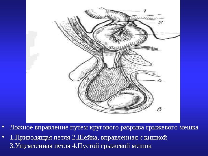   • Ложное вправление путем кругового разрыва грыжевого мешка • 1. Приводящая петля