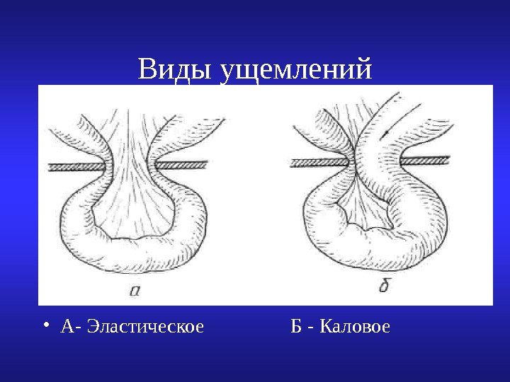   Виды ущемлений • А- Эластическое   Б - Каловое 