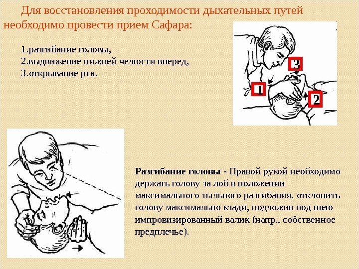 Для восстановления проходимости д ы хательных путей необходимо провести прием Сафара:  1. разгибание