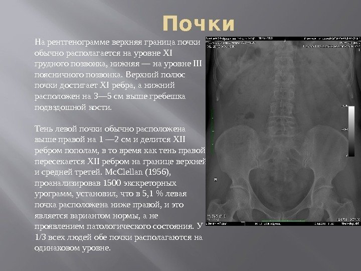 Почки На рентгенограмме верхняя граница почки обычно располагается на уровне XI грудного позвонка, нижняя