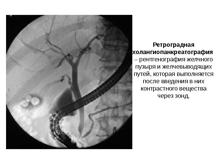 Ретроградная холангиопанкреатография – рентгенография желчного пузыря и желчевыводящих путей, которая выполняется после введения в