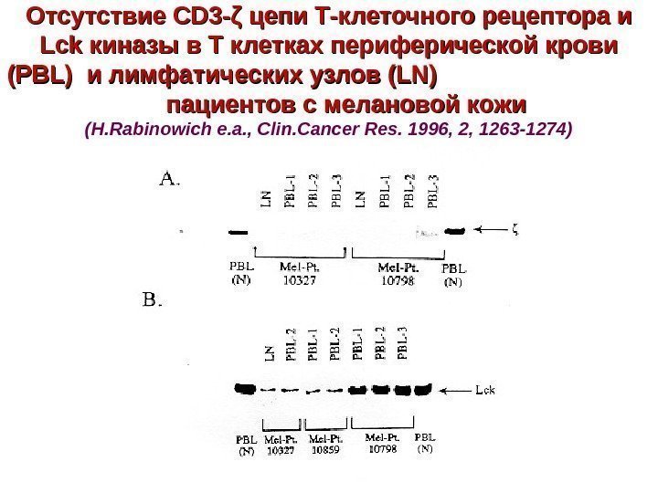 Отсутствие CD 3 - ζζ  цепи Т-клеточного рецептора и Lck киназы в Т