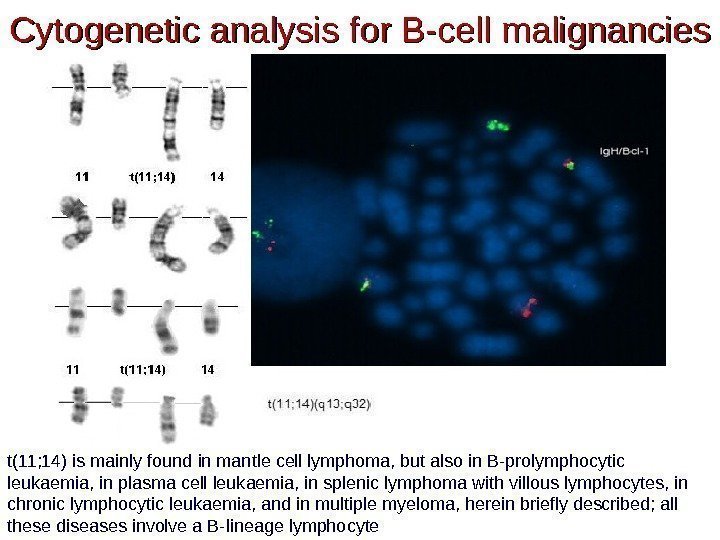 Cytogenetic analysis for B-cell malignancies t(11; 14) is mainly found in mantle cell lymphoma,