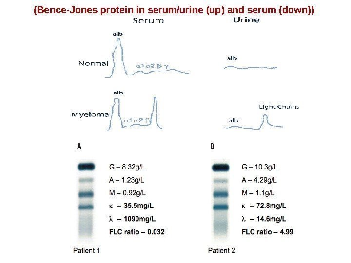 (Bence-Jones protein in serum/urine (up) and serum (down)) 