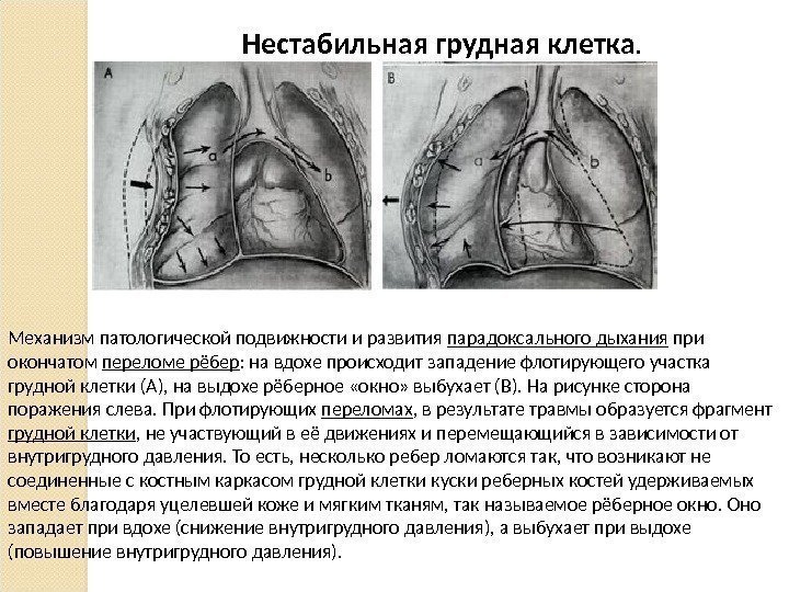 Нестабильная грудная клетка. Механизм патологической подвижности и развития парадоксального дыхания при окончатом переломе рёбер